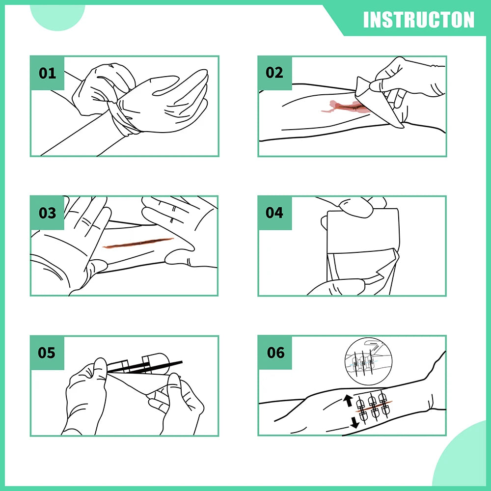 Rhino Rescue Zip Stitch Laceration Closure Kit for Cut Care - Safety First Gear 25